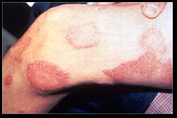 250px-leprosy_thigh_demarcated_cutaneous_lesions.jpg